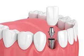 Dental-Implant